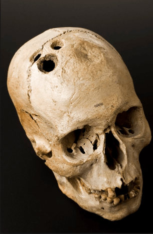 Trepanation er den gamle praksis med at bore et hul i kraniet. Det er en af ​​de ældste medicinske procedurer, som kendes af mennesker.