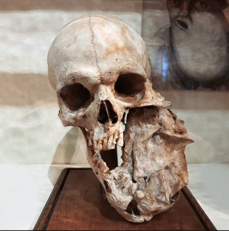 Kranium med en mandibulær tumor ved Bleuland -kabinettet i University Museum Utrecht, Holland