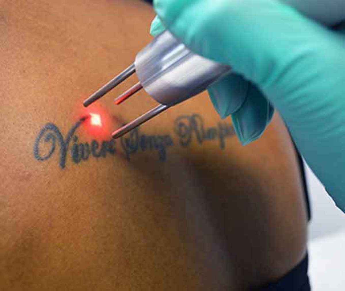 best-laser-tattoo-remove-machine