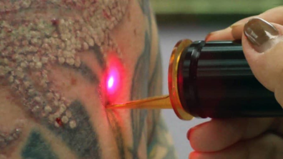 laser-tatuoinnin poisto
