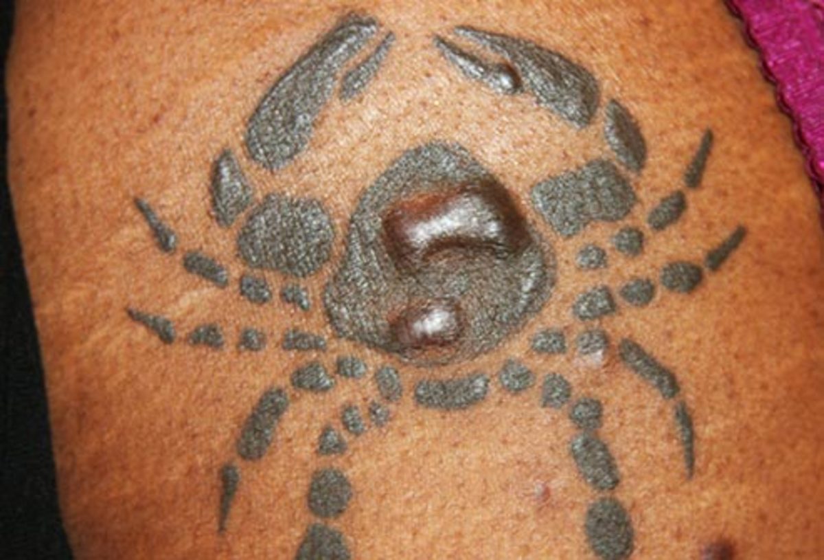 tatovering-årsag-keloid-af-tatovering-problemer-diasshow-når-tatoveringer-bliver-inficeret