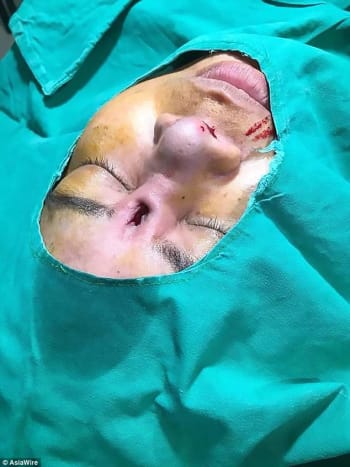 Φωτογραφία μέσω Dailymail Οι εικόνες δείχνουν ότι η μύτη της γυναίκας έχει μείνει με έναν κρατήρα όπου ήταν το εμφύτευμα σιλικόνης και δεν είναι βέβαιο πώς οι χειρουργοί σχεδιάζουν να επιδιορθώσουν τη σπασμένη ρινοπλαστική της, η οποία της άφησε μια τρύπα στο μέτωπό της.