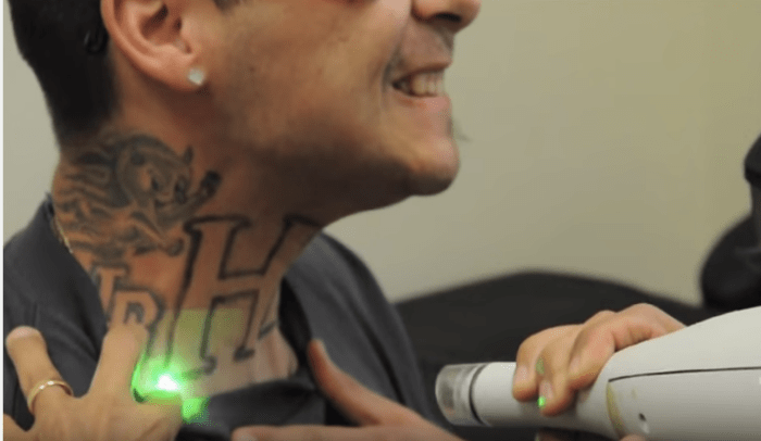 mies tatuoinnin poistamisesta