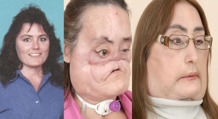 Foto via clevelandclinic Under et angreb fik Connie Culp et haglgevær i ansigtet. Heldigvis overlevede hun, men hun ville have brug for omfattende ansigtsoperationer, hvilket blev udført på Cleveland Clinic. Dette var den første næsten totale ansigtstransplantation udført i USA.