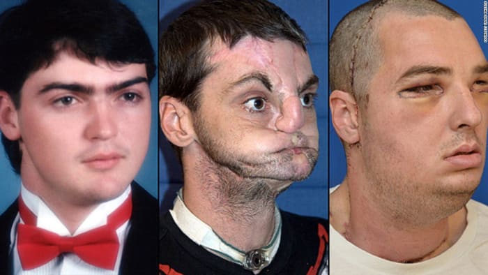Kuva cnnRichard oli komea nuori mies, kun hän valitettavasti joutui ase -onnettomuuteen, joka puhalsi pois merkittävän osan kasvojen alaosasta. Hänellä oli kirurginen naamio, joka peitti epämuodostuneet kasvonsa 15 vuoden ajan ennen kasvojen siirtoa.