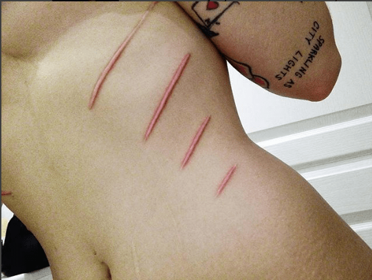 Foto fra Alderaan's Instagram Denne scarification helede meget godt og efterlod en lettelse på hendes krop.