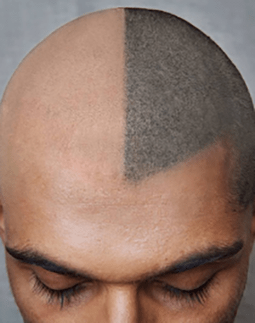 Mænd i publikum, lyt op. Du kan nu tatovere dit hoved for at forfalske et hårhår! Tal om spilændring.