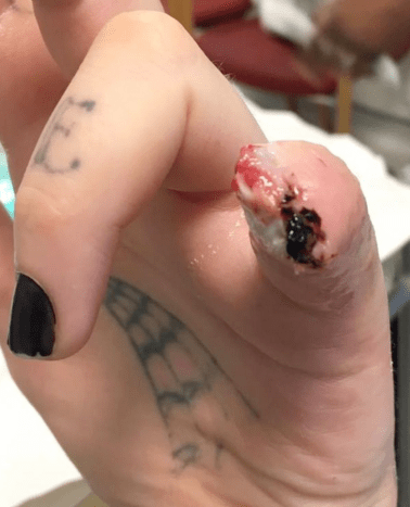 Το δάχτυλο του Torz Reynolds έκοψε τατουάζ με ροζ σώμα