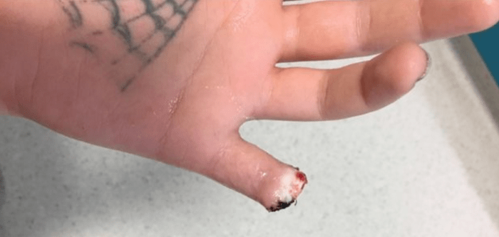 Το δάχτυλο του Torz Reynolds έκοψε τατουάζ με ροζ σώμα