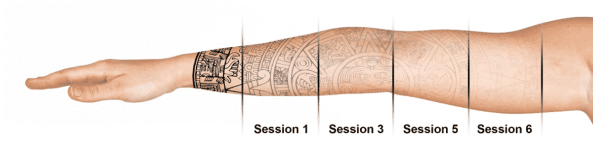 West-Seattle-laser-tatovering-fjernelse-Well-Medical-Arts-1024x269