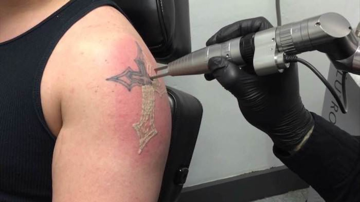 laser-tatovering-fjernelse