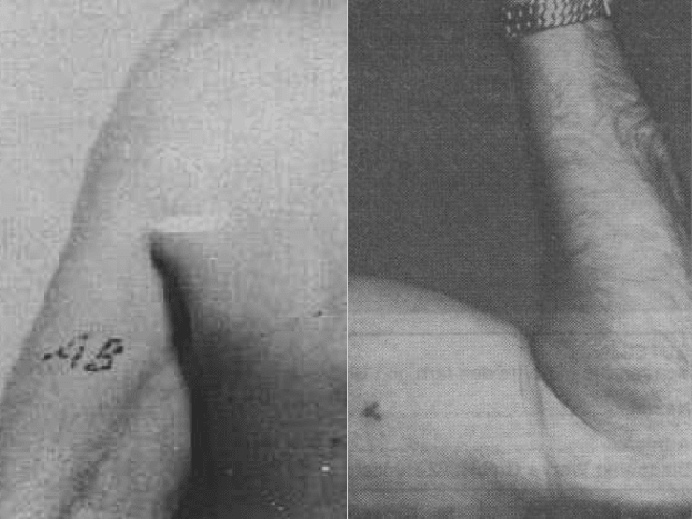 Φωτογραφία μέσω wiki Επίσημα όλα τα μέλη του Waffen-SS έκαναν τατουάζ στην ομάδα αίματος στο εσωτερικό του αριστερού βραχίονα. Ένας ιατρός μονάδας το εφάρμοσε, συνήθως κατά τη διάρκεια της βασικής εκπαίδευσης. Εάν κάποιος άντρας έχασε το τατουάζ, έπρεπε να εφαρμοστεί κατά τη διάρκεια της επακόλουθης ιατρικής θεραπείας.