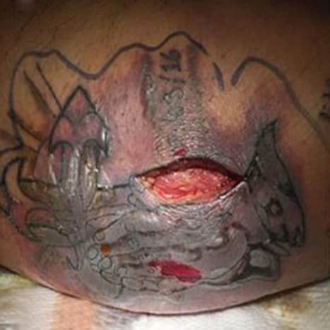 Kuva BMJ CASESin kautta pian miehen kuoltua, kun lääkärit havaitsivat syyt yhdistelmästä maksasairautta, munuaisten vajaatoimintaa ja nekroottisia ihovaurioita (lihansyömisairaus), jotka johtuivat Vibrio vulnificuksen aiheuttamasta tatuoinnista uidessaan Meksiko. Viisi päivää sen jälkeen, kun mies oli ottanut tatuoinnin, hän päätti uida Meksikonlahdella. Se osoittautui kohtalokkaaksi virheeksi.