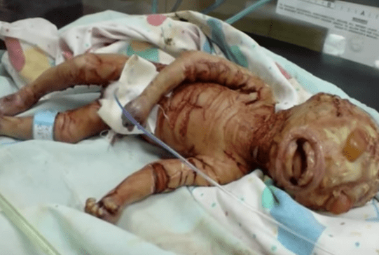 baby født uden hud