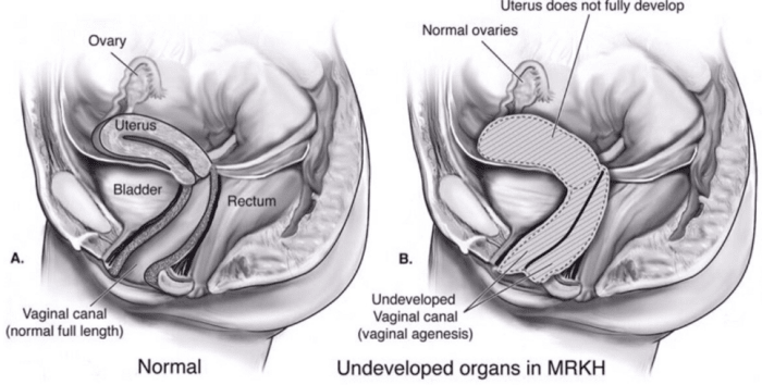 MRKH: sta on useita muunnelmia, joissa lisääntymiselimet ovat joko alikehittyneitä tai puuttuvat kokonaan. Kuitenkin ulkoiset sukupuolielimet ja rintojen kehitys ovat tyypillisesti normaaleja naisilla, joilla on MRKH.