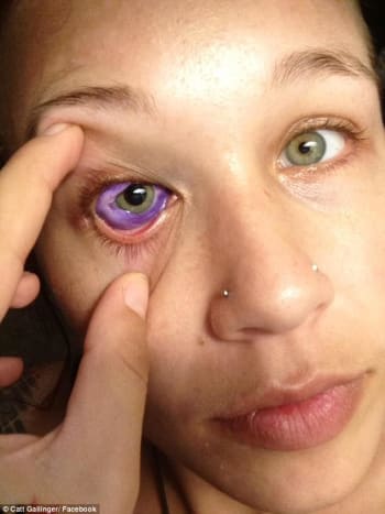 Foto via Catt Gallinger Efter at have undersøgt hendes øje konkluderede lægerne, at Gallingers øje var permanent beskadiget og havde potentiale til at blive fjernet i fremtiden.