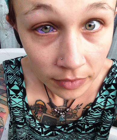 Foto via Catt Gallinger Den 24-årige begyndte at lægge mærke til, at hendes nye blæk ikke var helt i orden, da blækket begyndte at dryppe fra hendes øje og klumpede rundt om hendes hornhinde.