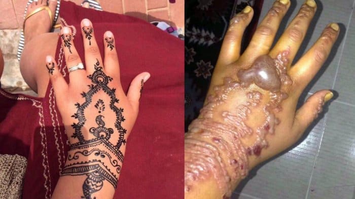 Η Σόφι, μια 22χρονη Αγγλίδα, έκανε διακοπές στο Μαρόκο όταν αποφάσισε να πάρει χέννα στα χέρια της. Η Sophie περίμενε πραγματικά 24 ώρες για να δει αν το δέρμα της θα είχε αλλεργική αντίδραση, κάτι που δεν έγινε. Πλήρωσε τα 10 δολάρια και έκανε την χέννα. Μέσα σε λίγες ώρες τα χέρια της είχαν πρηστεί και φούσκωναν.