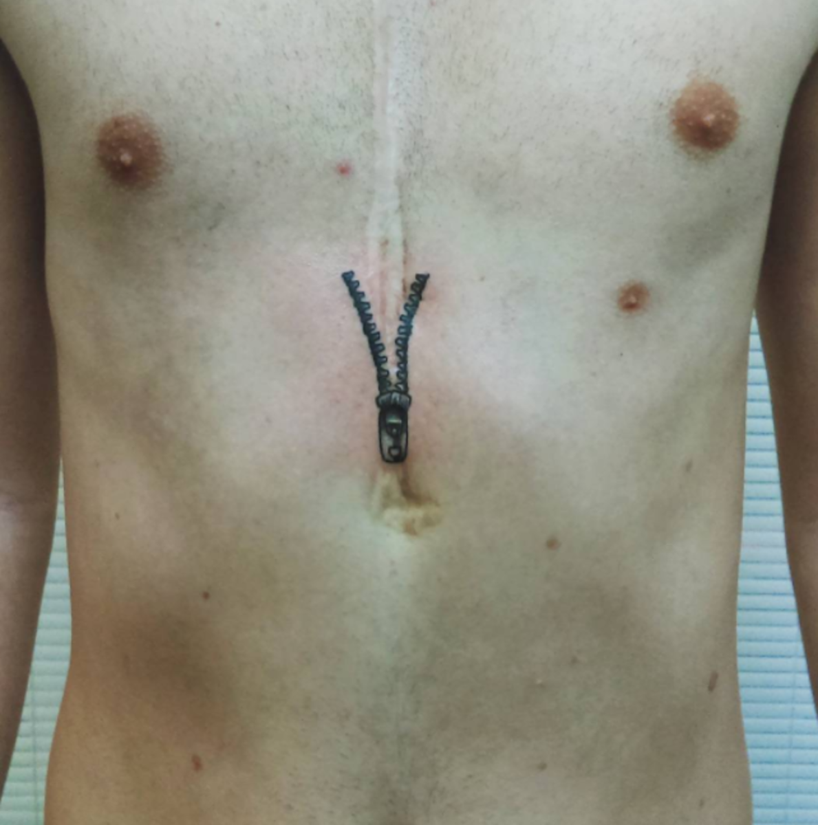 ανοιχτή καρδιά χειρουργική επέμβαση τατουάζ