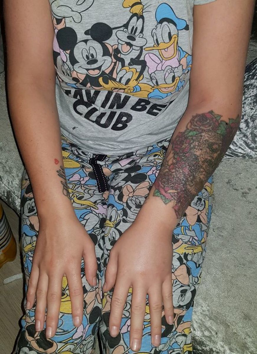 Stephanie Lynn, σάρκα που τρώει σφάλματα, η αφαίρεση τατουάζ πήγε στραβά, αναβάλλει το γάμο, φρέσκο ​​πρόσωπο, αφαίρεση λέιζερ, αφαίρεση τατουάζ