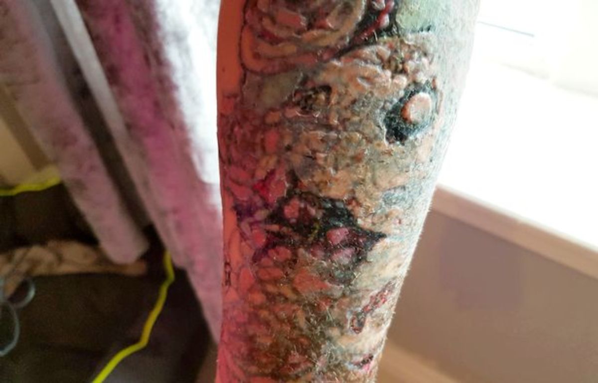 Stephanie Lynn, σάρκα που τρώει σφάλματα, η αφαίρεση τατουάζ πήγε στραβά, αναβάλλει το γάμο, φρέσκο ​​πρόσωπο, αφαίρεση λέιζερ, αφαίρεση τατουάζ