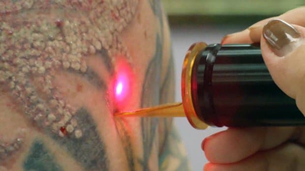 Markkinatutkimuksen tulevaisuuden julkaisema tutkimus osoittaa, että vuoteen 2022 mennessä tatuointien poistomarkkinoiden odotetaan nousevan 3,5 miljardiin dollariin! Vaikka tutkimukseen sisältyy kirurgia, voiteet ja muut poistot, laser on suosituin muoto ja hallitsee tatuointien poistomenetelmiä. Laserpoistolla oli suurin markkinaosuus vuodesta 2015, ja sen odotetaan edelleen johtavan markkinoille vuoteen 2022 mennessä. Market Watchin mukaan tatuointien poistotulot ovat nousseet 440% ja arvioitu 75,5 miljoonaan dollariin viimeisen vuosikymmenen aikana, tatuointien poistojen odotetaan saavuttavan ensi vuonna 83,2 miljoonaa dollaria. Laser-tatuointien poistoklinikoilla, kuten Tatt-Away Tampa, Fla, poistetaan yli 300 tatuointia kuukaudessa lähes 500 dollarilla pop, tämä luku ei ole yllätys.