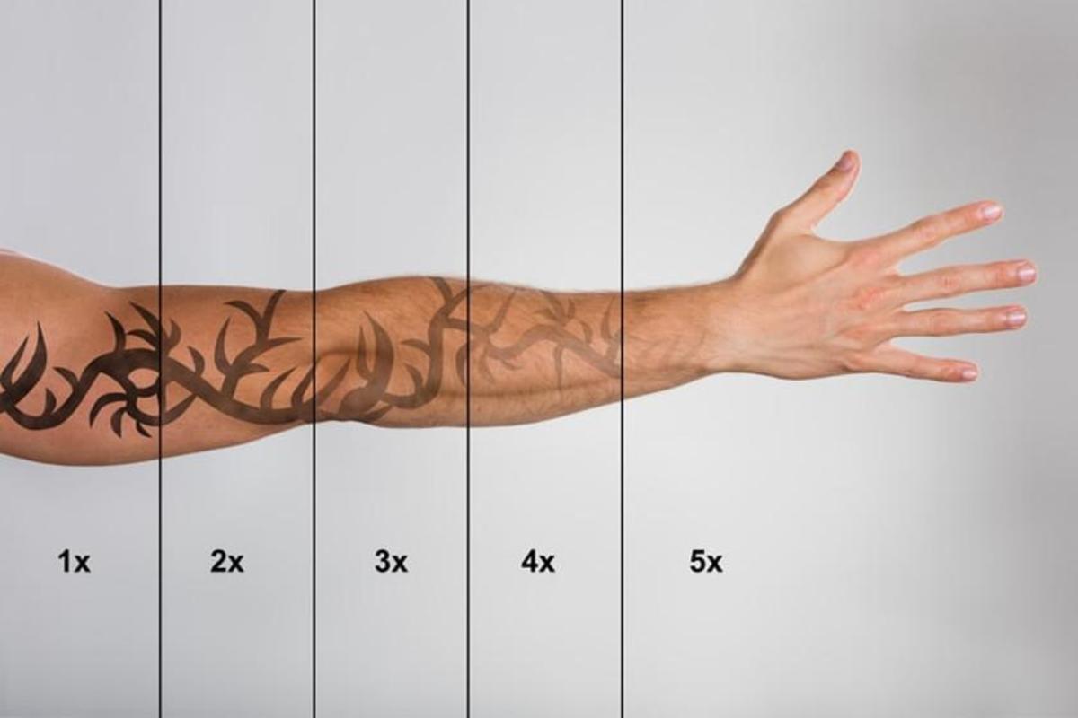 αισθητική-τεχνικός λέιζερ-αφαίρεση τατουάζ