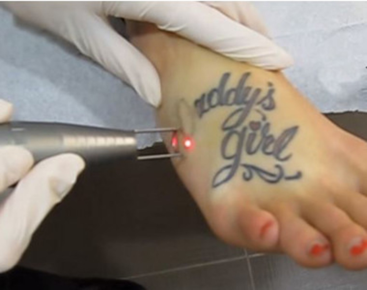 tatovering-fjernelse